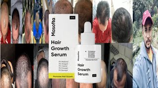 Masofta Hair Growth Serum  Honest Review [upl. by Marty817]