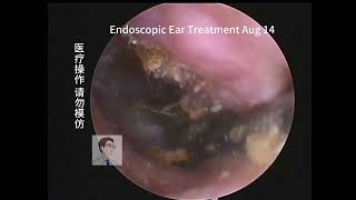 Cerumen cleaning of artificially excavated narrow ear canals，20230814 [upl. by Kreindler]