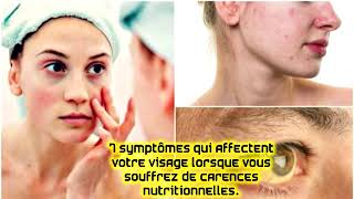 7 symptômes qui affectent votre visage lorsque vous souffrez de carences nutritionnelles [upl. by Fletcher106]