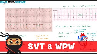 Rate and Rhythm  Supraventricular Tachycardia SVT and WolffParkinsonWhite WPW Syndrome [upl. by Nager]