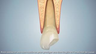 les Couronnes dentaires sur une dent sur plusieurs sur implant [upl. by Akcira881]