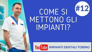 COME SI METTONO GLI IMPIANTI IMPIANTI DENTALI TORINO [upl. by Llig484]