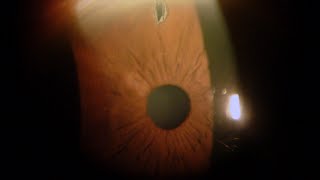 Iridotomia Laser per Glaucoma  Studi Oculistici Abbondanza [upl. by Arotal]