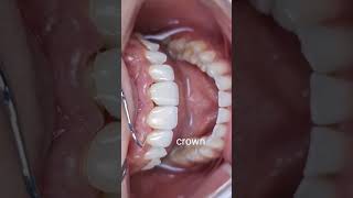 Veneers vs Crown  Front Teeth  Aesthetic  Dentistry [upl. by Attolrac897]