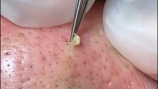 EXTRACTING plugged pores on the nose [upl. by Caputto144]