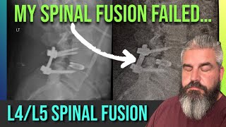 L4L5 Spinal Fusion Failure 2 Weeks After SurgeryNow WHAT [upl. by Htrahddis]