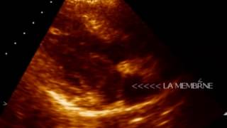 COR  TRIATRIATUM SINISTER  ECHOCARDIOGRAPHY SERIES BY DR ANKUR K CHAUDHARI [upl. by Grazia]