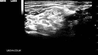 Ultrasound Guided Interscalene Brachial Plexus Block [upl. by Amarillas]