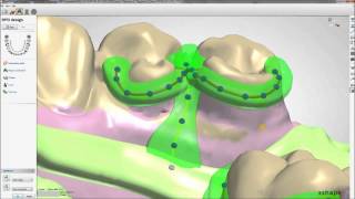 Removable Partial Dentures Design with 3Shape  Maptec KSA [upl. by Girish]