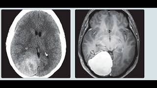 Aicardi syndrome brain imaging radiology cases [upl. by Oicnanev]