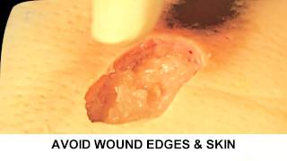 Enzymatic Debridement Demonstration Understand Wound Care [upl. by Dijam]