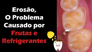 Erosão Dentária  Descubra Como Tratar o Desgaste Dentário Causado por Frutas e Refrigerantes [upl. by Karine]