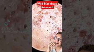 SHOCKING BLACKHEAD REMOVAL  What Is Happening shorts [upl. by Lorenzana]