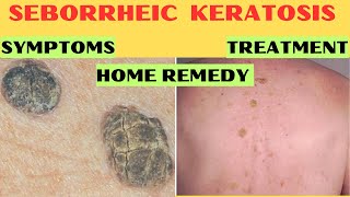 Understanding Seborrheic Keratosis Causes Symptoms Treatment Home Remedies [upl. by Agnella934]