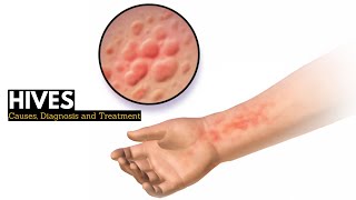 HIVES Causes Signs and Symptoms Diagnosis and Treatment [upl. by Alberto441]