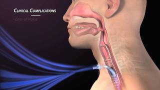 Clinical Complications of Tracheostomy [upl. by Ginni]