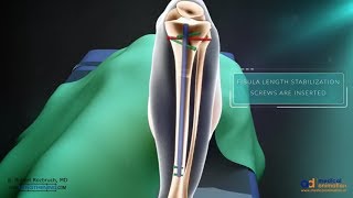 Precice Tibia Lengthening Surgical Animation [upl. by Cormick365]