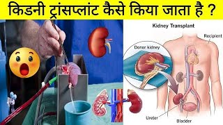 kidney transplant kya hota hai like facts viralvideo science share subscribe youtuviralvideo [upl. by Ardnoek299]