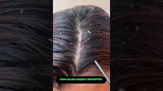 Dermatite seborreica beleza tricologia terapiacapilarintegrativa cabelo clinicacapikar [upl. by Drusus276]