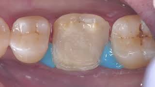 Root canal treatment followed by preliminary overlay preparation A detailed video [upl. by Yaker715]