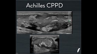 Achilles CPPD [upl. by Dewayne825]