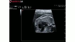 Ultrasound video of Membranous VSD and overriding aorta [upl. by Llenrub]