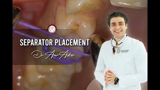 separator placement in orthodontics for HYRAX by Dr Amr Asker [upl. by Elokyn]