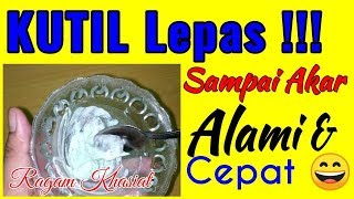 Cara Mencabut Kutil Sampai Akarnya  Alami Dan Cepat [upl. by Iams]