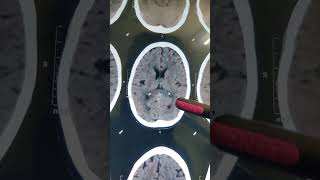 INTRACRANIAL CALCIFICATION doctor hospital  shorts video [upl. by Dazraf]