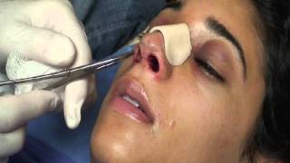 The Kotler Nasal Airway  Removal of the Airway [upl. by Llehsim427]