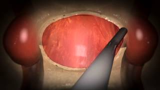 Updated Video Available Endoscopic Endonasal Pituitary and Skull Base Surgery [upl. by Mala]