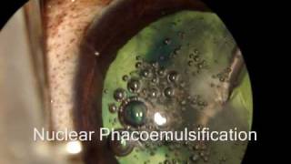 Phacoemulsification in a dog followed by an IOL implant [upl. by Ruder]