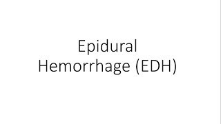 Epidural Hemorrhage  Extradural Hematoma EDH  General Surgery [upl. by Philips]