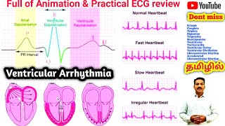 Ventricular Arrhythmia in tamil  couplet triplets flutter Fibrillation bigeminy trigeminy [upl. by Shulock514]