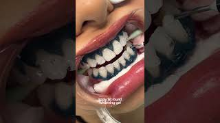 teeth whitening process 🦷 torontoteethwhitening teethwhitening [upl. by Reese]