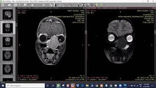 Left nasal cavity Ossifying Fibroma  Endoscopic excision  Dr Satish Jain [upl. by Dnaletak]