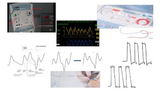 Balloon pump hemodynamics troubleshooting technical tips Elias Hanna [upl. by Nigam24]