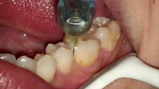 Endodontia de Molar Inferior [upl. by Cairistiona]