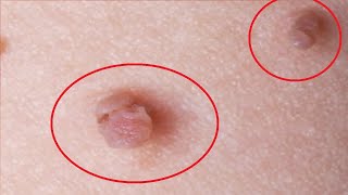 how to get rid of skin tags with dental floss [upl. by Higbee]