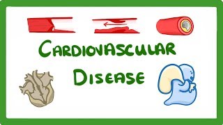 GCSE Biology  Why Do We Get Heart Disease and How to Treat It  Cardiovascular Disease CVD 47 [upl. by Anatola]