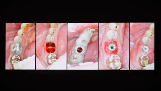 Case story predictable workflow for precision fitting healing abutment [upl. by Artinahs]