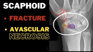 Anatomical Snuff box Part 2 Scaphoid  Fracture AVN  In 3 MINUTES [upl. by Annayoj28]