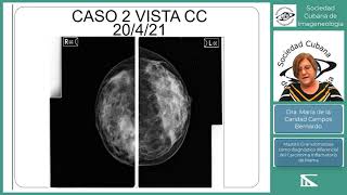 Mastitis granulomatosa diagnóstico diferencial del cáncer de mama Dra Maria Caridad Campos [upl. by Nwahsauq437]