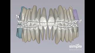 Dr Sean K Carlson from Simple Orthodontics in Marin demonstrates hightech braces [upl. by Zach]