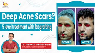 5 levels in Facial Fat Grafting  Permanent Acne Scar Treatment in Bangalore  Venkat Center [upl. by Centeno]