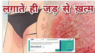 Dermiford Cream  Uses Side effectsReviews Composition In Hindi [upl. by Marie75]