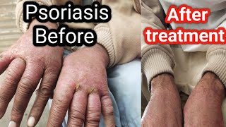 psoriasispsoriasis patient after treatment [upl. by Ozzie]