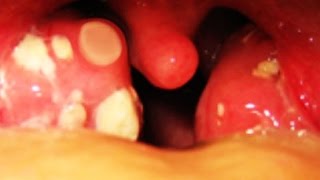 Worlds Greatest Tonsil Stone Removals [upl. by Lseil626]