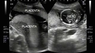 Ultrasound Video showing double placenta in twin pregnancy [upl. by Rochester]