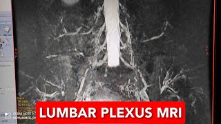 Lumbar Plexus MRI [upl. by Jada]